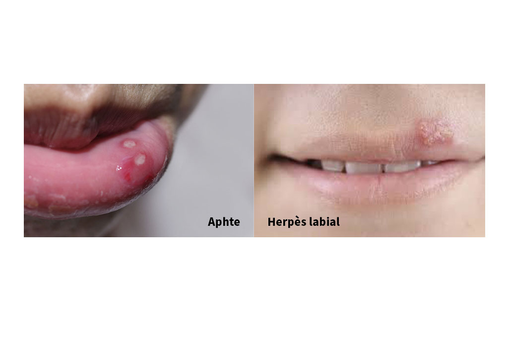 Aphte ou feu sauvage, comment les diffrencier? - Clinique Dentaire  Beaulieu, Lapointe et Associs  Laval
